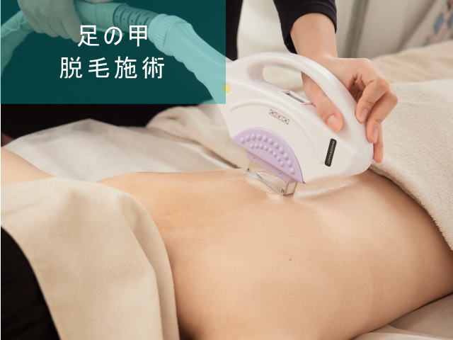 足の甲脱毛Step4