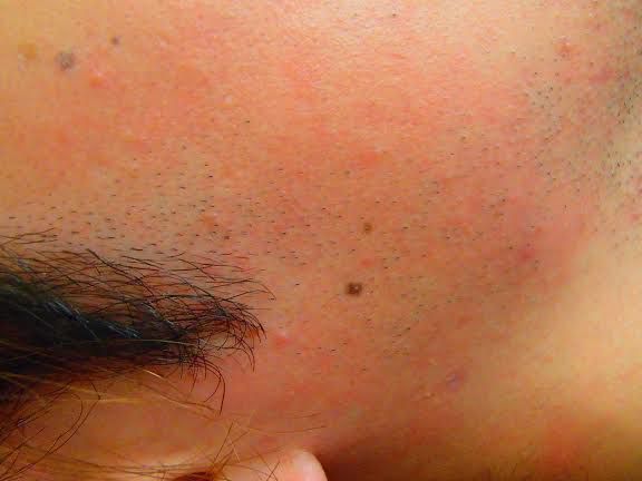 もみあげ脱毛Before