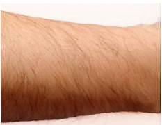 ひじ下脱毛Before