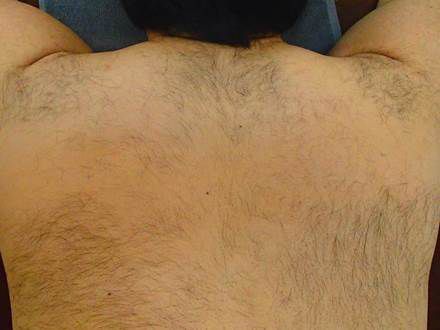背中上脱毛Before