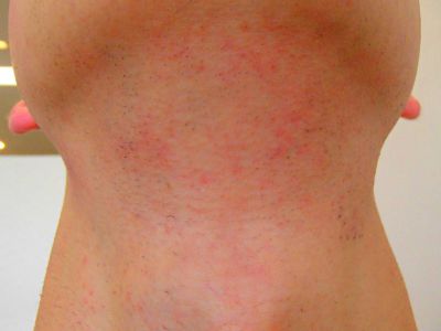 首ひげ脱毛After