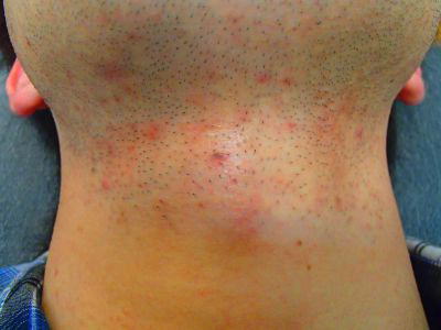 首ひげ脱毛Before