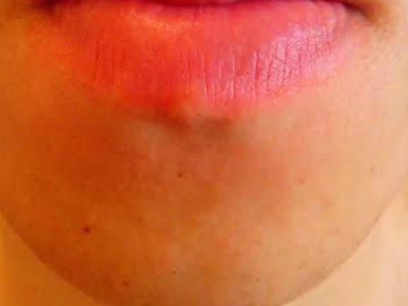 口下ひげ脱毛After